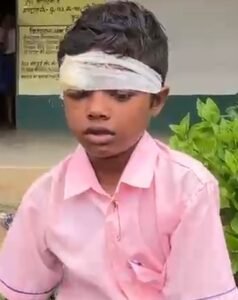 सरायकेला में प्रधानाध्यापक पर बच्चे को पीटकर सिर फोड़ने का आरोप, ग्रामीणों में आक्रोश; कार्रवाई की मांग